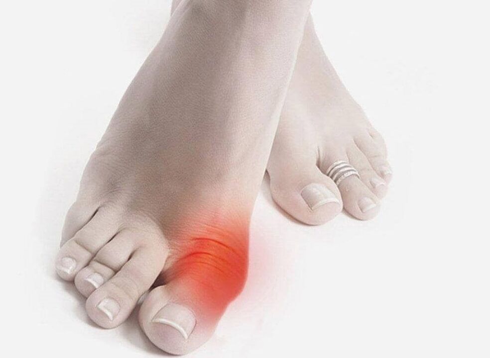 Gout symptoms
